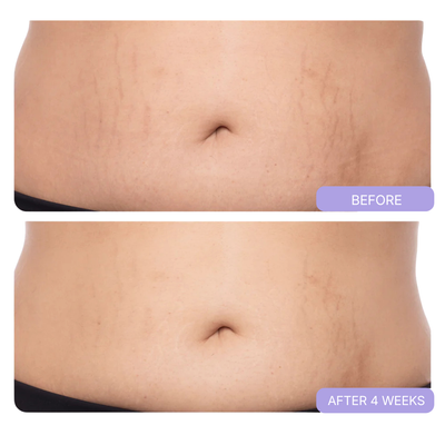 BELLYNOVA™ Tighten & Smooth Belly Cream