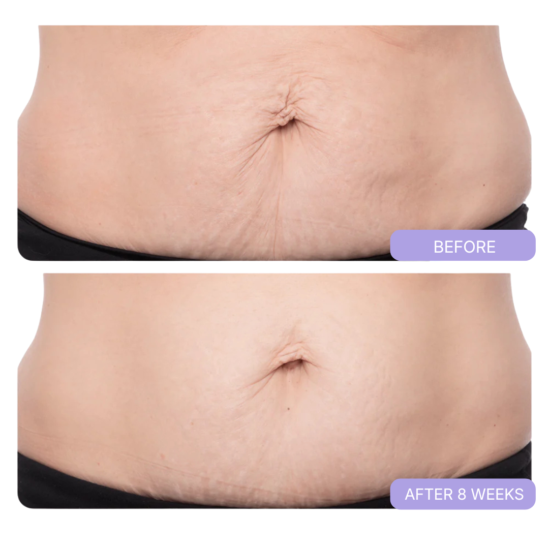 BELLYNOVA™ Tighten & Smooth Belly Cream