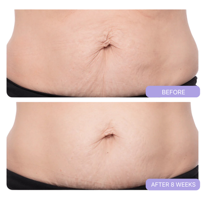 BELLYNOVA™ Tighten & Smooth Belly Cream